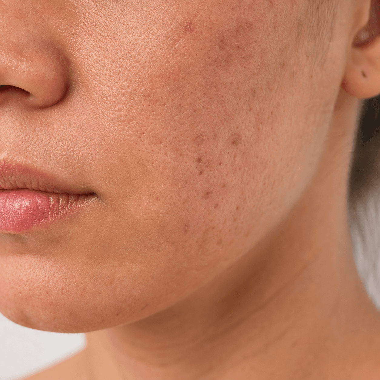 Detalhe de marcas de acne