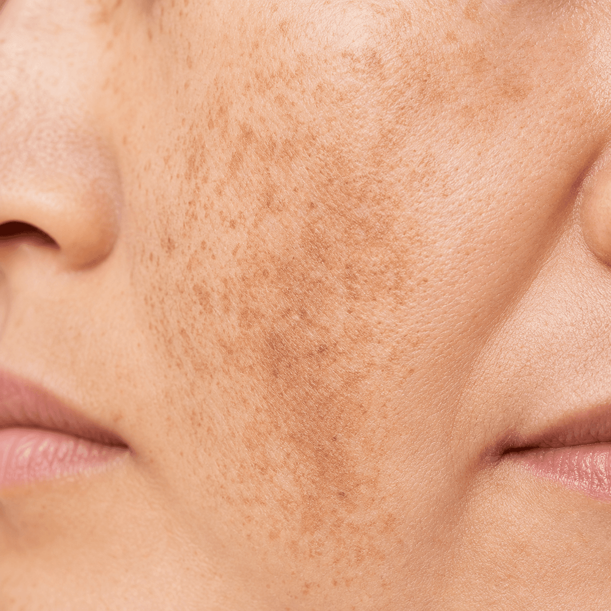 Detalhe de melasma
